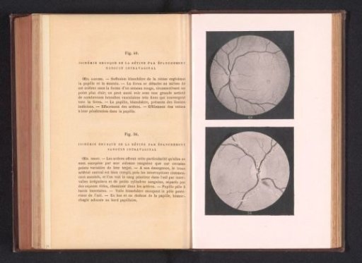 Photographic reproduction of two anatomical drawings of insufficient blood circulation in an eye