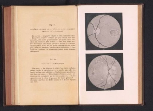 Photographic reproduction of two anatomical drawings of insufficient blood circulation in an eye and a retina