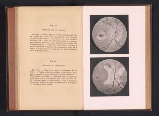 Photographic reproduction of two anatomical drawings of a disease of the retina