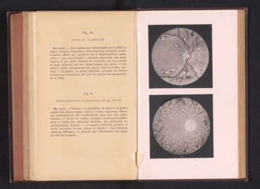 Photographic reproduction of two anatomical drawings of conditions of the retina