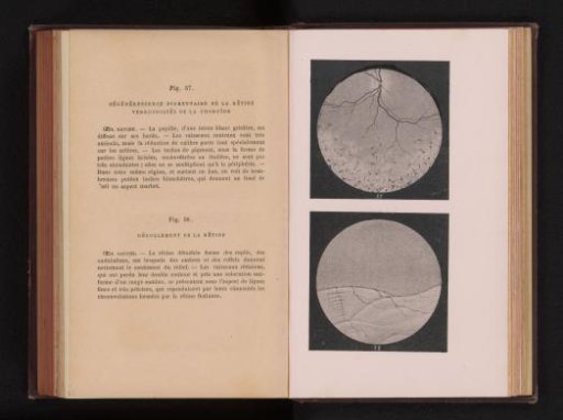 Photographic reproduction of two anatomical drawings of conditions of the retina