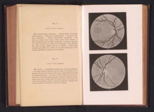 Photographic reproduction of two anatomical drawings of a normal eye