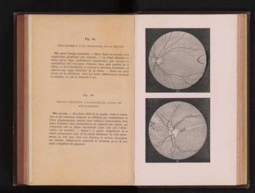 Photographic reproduction of two anatomical drawings of retinal detachment