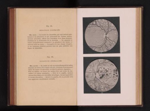 Photographic reproduction of two anatomical drawings of inflammation of the uvea in an eye
