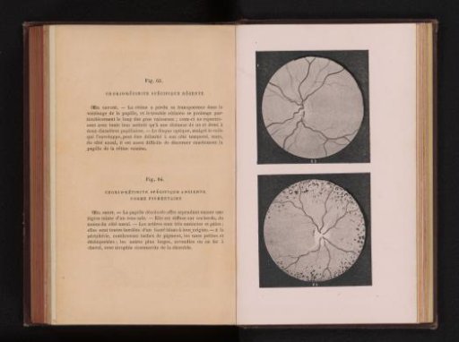 Photographic reproduction of two anatomical drawings of inflammation of the uvea in an eye