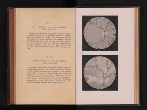 Photographic reproduction of two anatomical drawings of inflammation of the uvea in an eye