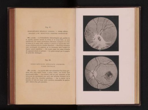 Photographic reproduction of two anatomical drawings of inflammation of the uvea in an eye