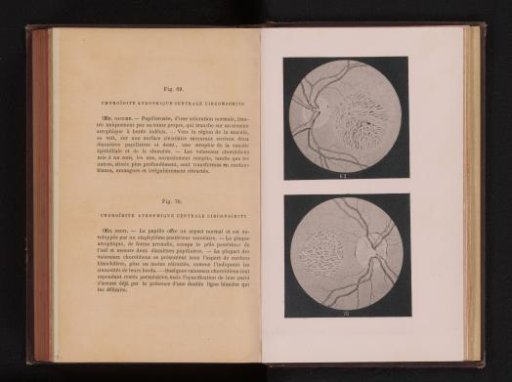 Photographic reproduction of two anatomical drawings of an inflammation of the uvea in an eye
