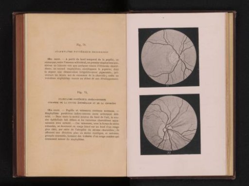 Photographic reproduction of two anatomical drawings of staphyloma of the eye