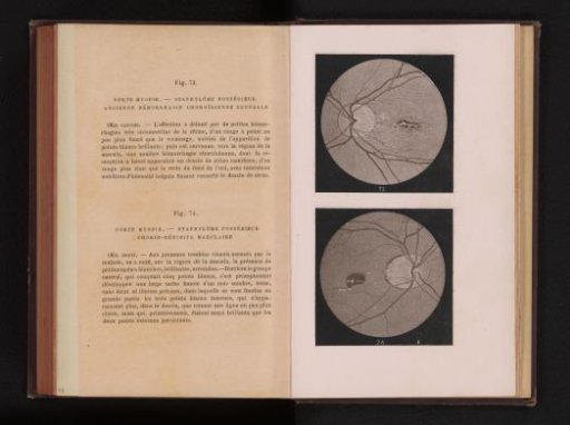 Photographic reproduction of two anatomical drawings of the eye of a myopic person