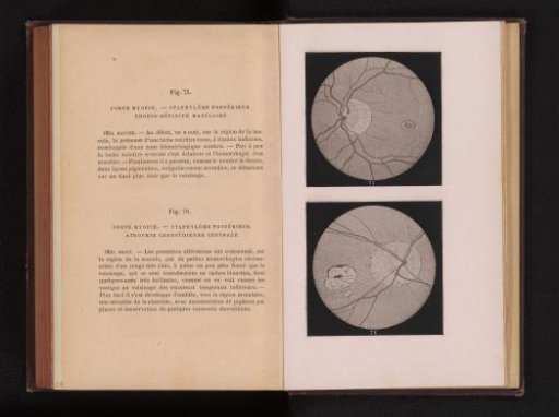 Photographic reproduction of two anatomical drawings of the eye of a myopic person