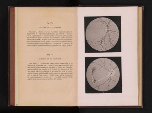 Photographic reproduction of two anatomical drawings of a rupture of the uvea in an eye