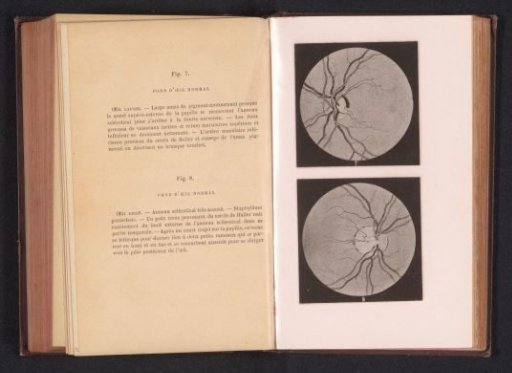 Photographic reproduction of two anatomical drawings of a normal eye