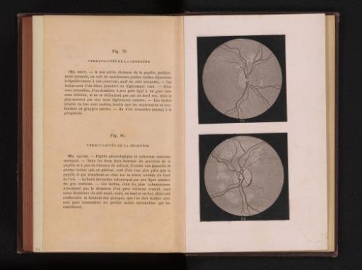 Photographic reproduction of two anatomical drawings of a tumor on the uvea in an eye