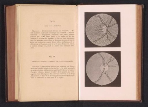 Photographic reproduction of two anatomical drawings of an eye of an albino and an eye with a nerve disorder