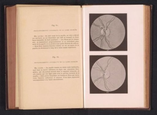 Photographic reproduction of two anatomical drawings of an eye with an enlarged lamina cribrosa