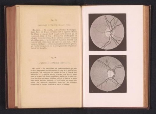 Photographic reproduction of two anatomical drawings of nerves in an eye and a staphyloma on an eye
