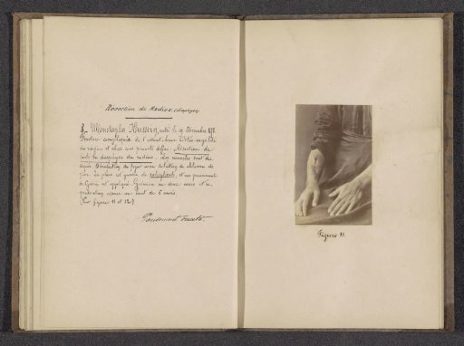 Forearms of Moustapha Houssein after an operation