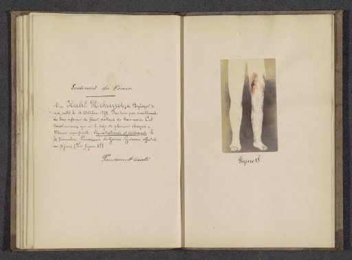 Photographic reproduction of a drawing depicting the legs of Halil Mehemet after an operation on his thigh