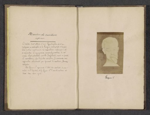 Photographic reproduction of a drawing depicting a patient with hypertrophy of the tongue