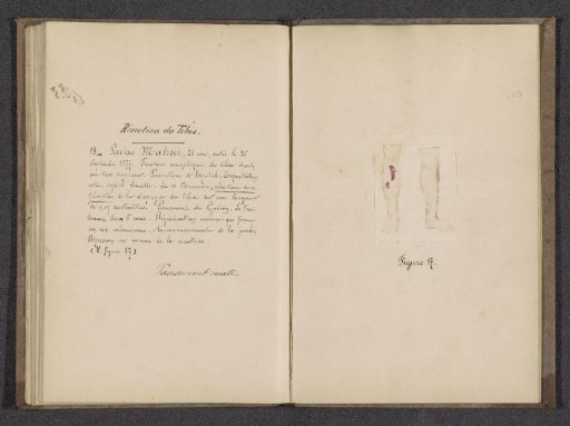 Photographic reproduction of a drawing depicting the legs of Pacha Mahsel before an operation on his shin