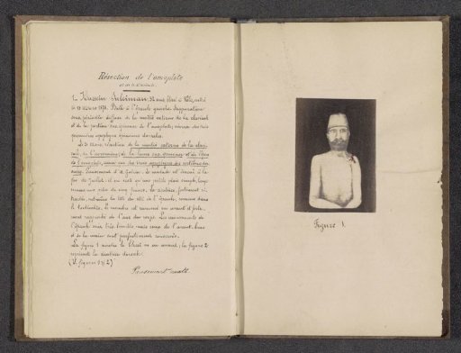 Photographic reproduction of a drawing depicting Hussein Suleiman, a patient with inflammation of the shoulder blade due to a gunshot wound