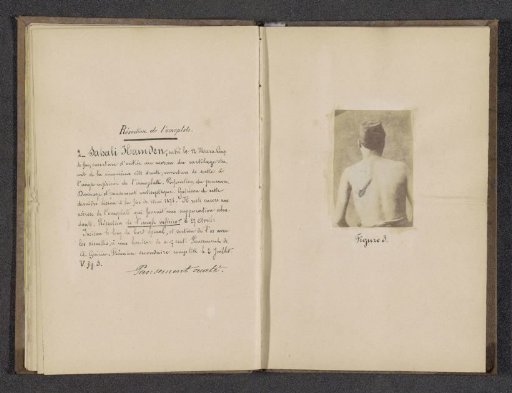 Sahali Hainden, a patient with a gunshot wound in his shoulder blade, seen from the back