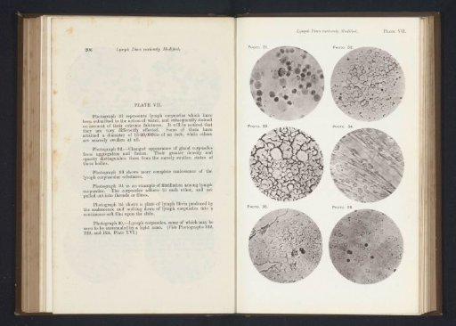 Six enlargements of lymphocytes