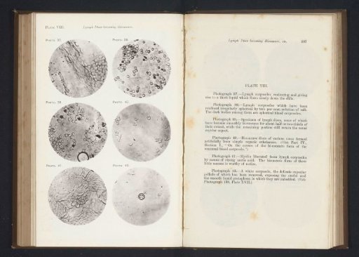 Six enlargements of lymphocytes