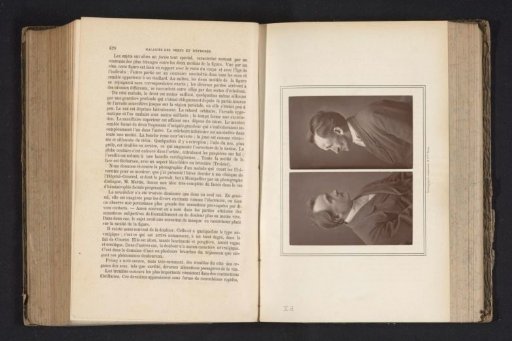 Two Portraits of a Patient with Parry–Romberg Syndrome