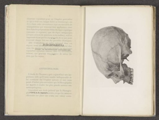 Human skull with a deformation
