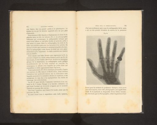 X-ray photograph of a hand with a ring