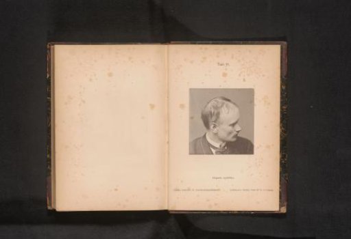 Unknown man with hair loss caused by syphilis