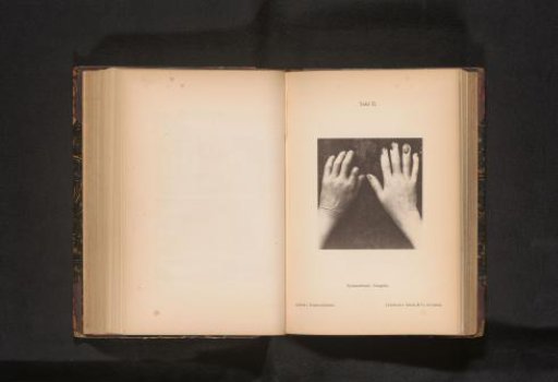 Hands affected by gangrene