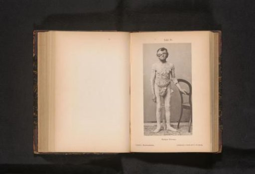 Portrait of an unknown man with fibromas