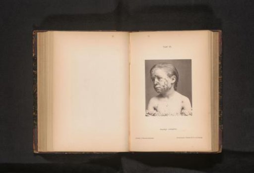 Portrait of an unknown child suffering from impetigo