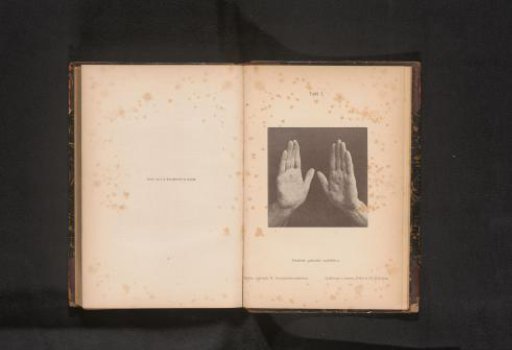 Hands with skin rash caused by syphilis