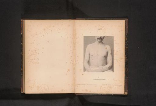 Unknown man with skin rash caused by syphilis