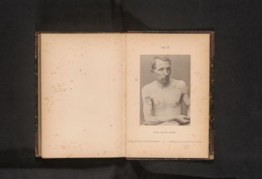 Unknown man with skin rash caused by syphilis