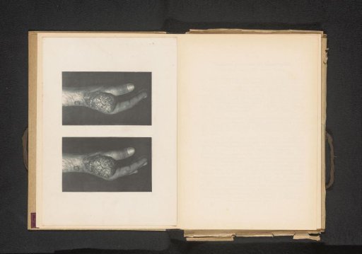 Two views of a hand with a carcinoma
