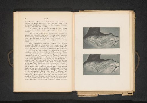 Two views of a sole with symptoms of syphilis