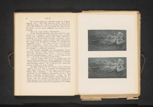 Two views of a large intestine with ulcers as a result of syphilis