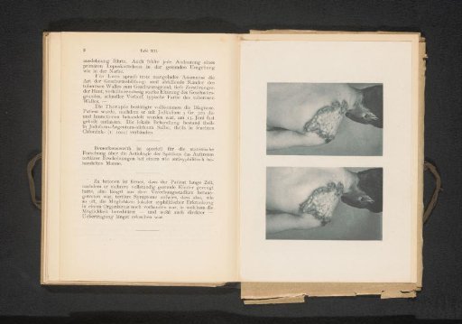 Two views of a patient with skin ulcers on the back caused by syphilis