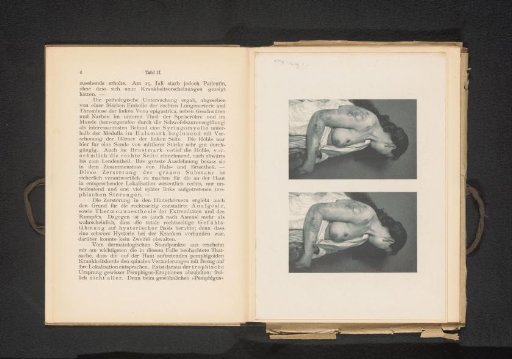 Two views of a woman with symptoms of pemphigus caused by syringomyelia