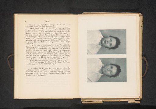 Two portraits of a woman with blisters on the head caused by the Spanish fly