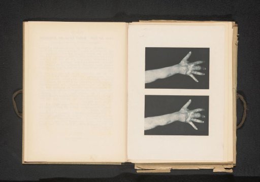 Two views of an arm with symptoms of cutaneous lupus