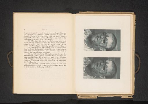 Two portraits of a patient with symptoms of cutaneous tuberculosis on the face