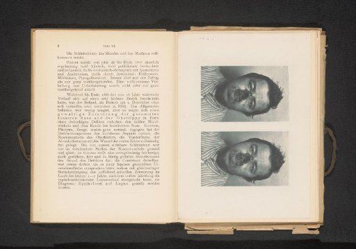Two portraits of a patient with a carcinoma caused by cutaneous lupus