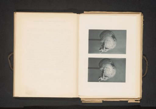 Two views of a skull with consequences of syphilis on the skullcap