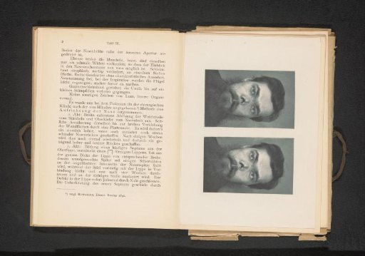 Two portraits of a man with a saddle nose due to a missing nasal septum as a result of syphilis